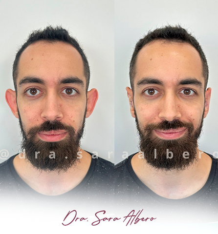 Dra.-Sara-Albero-Orelhas-de-abano-antes-e-depois