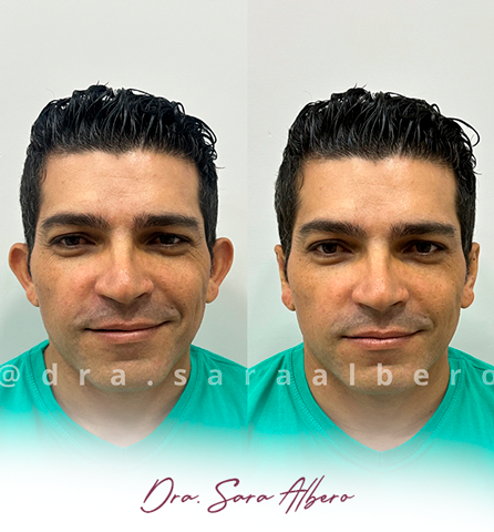 Dra.-Sara-Albero-Orelhas-de-abano-antes-e-depois