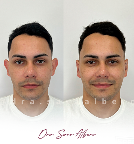 Dra.-Sara-Albero-Orelhas-de-abano-antes-e-depois