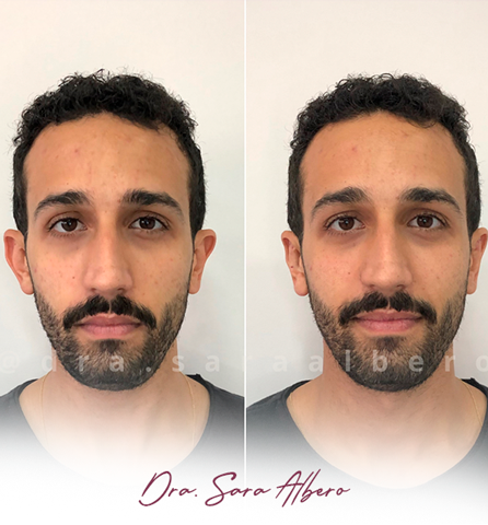 Dra.-Sara-Albero-Orelhas-de-abano-antes-e-depois