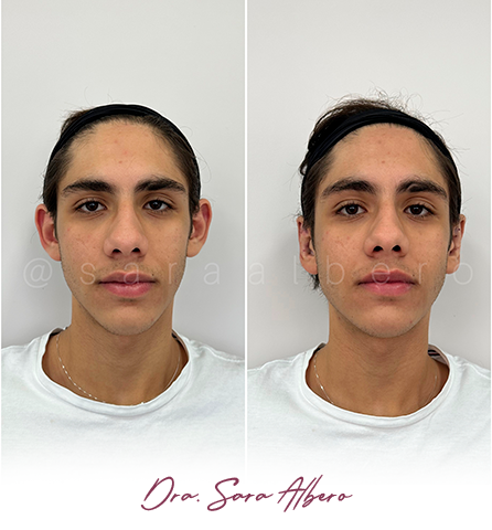 Dra.-Sara-Albero-Orelhas-de-abano-antes-e-depois-7.1