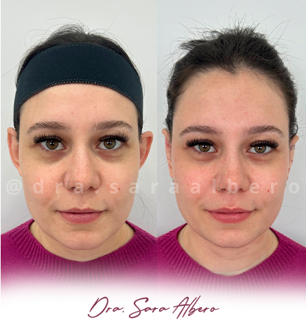 Dra.-Sara-Albero-Orelhas-de-abano-antes-e-depois-7.11