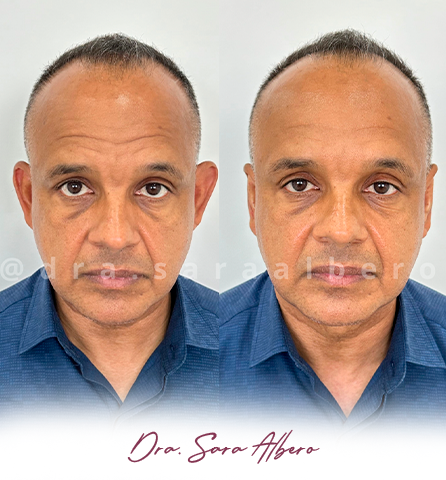 Dra.-Sara-Albero-Orelhas-de-abano-antes-e-depois-7.12