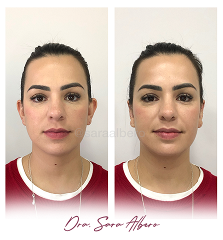 Dra.-Sara-Albero-Orelhas-de-abano-antes-e-depois-7.4