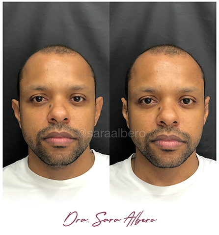 Dra.-Sara-Albero-Orelhas-de-abano-antes-e-depois-7.7