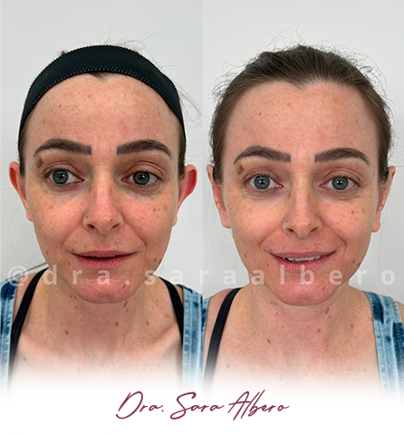 Dra.-Sara-Albero-Orelhas-de-abano-antes-e-depois-7.9